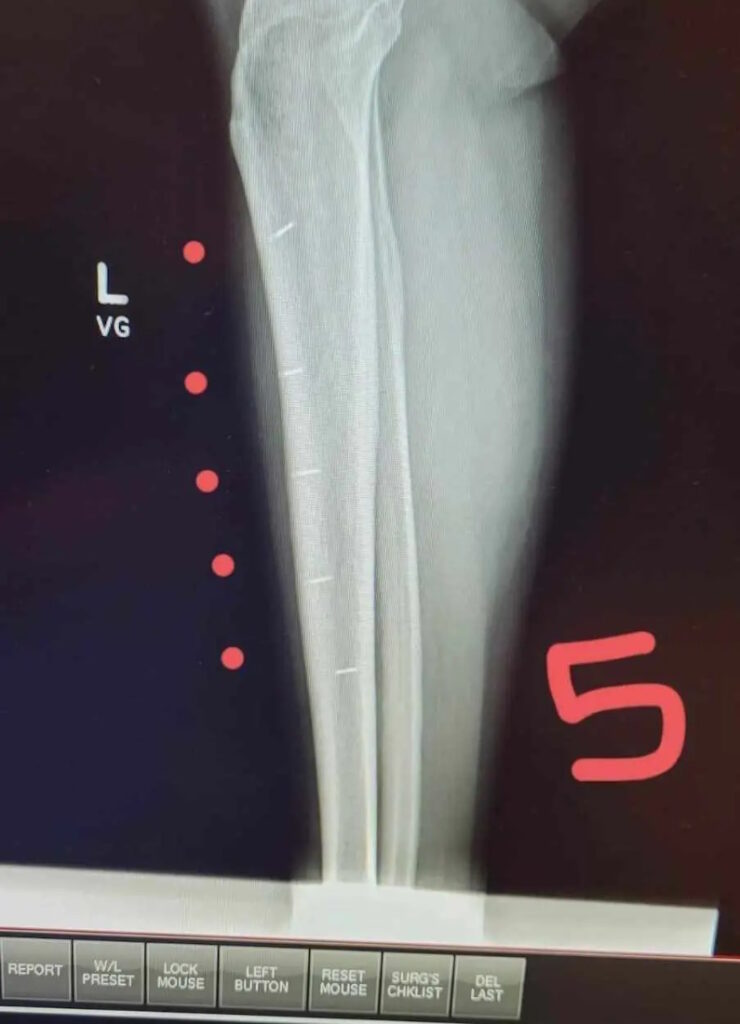 زن شعبده باز رکورددار بیشترین ایمپلنت تکنولوژیکی در بدن + ویدئو