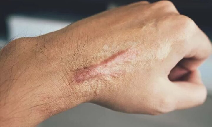 قبل از انجام لیزر این نکات را بخوانید - غروب شهر 2 قبل از انجام لیزر این نکات را بخوانید