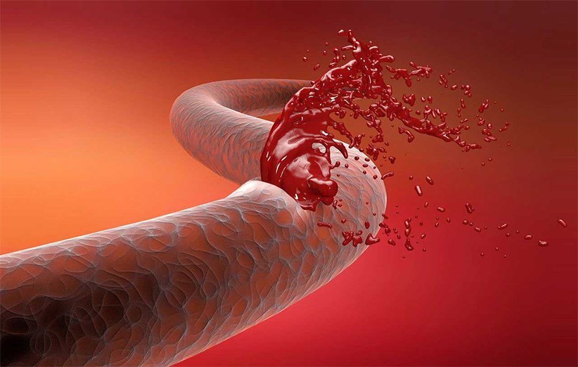 توقف خونریزی در ۳۰ ثانیه ممکن شد/ انقلاب جدید دانشمندان ایرانی در فناوری پزشکی توقف خونریزی در ۳۰ ثانیه ممکن شد/ انقلاب جدید دانشمندان ایرانی در فناوری پزشکی
