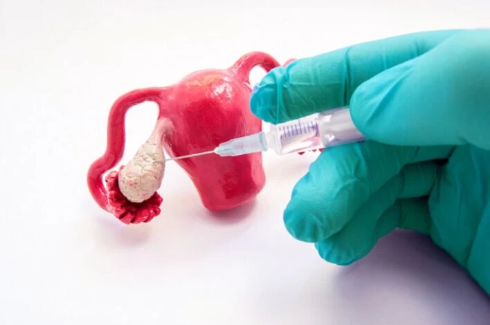 پشت‌ صحنه لقاح مصنوعی در ایران؛ روایتی از امید و انتخاب‌های دشوار